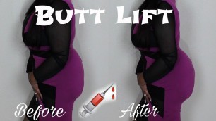 'BUTT LIFT, ILLEGAL BUTT SHOTS, BBL\'S! LET\'S TALK BUTTS AND TIPS'