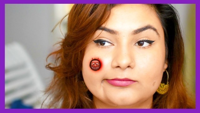 'BEST natural remedy for Pimples {Delhi fashion blogger}'